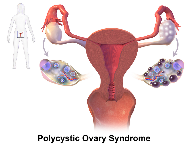 Illustration showing manifestation and location of polycystic ovary syndrome