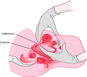 Illustration showing assessment for hegar's sign