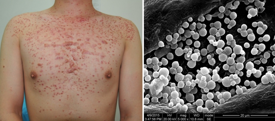 Photo showing fungal folliculitis on a patient's chest along with a scanning electron microscope image of an affected hair follicle