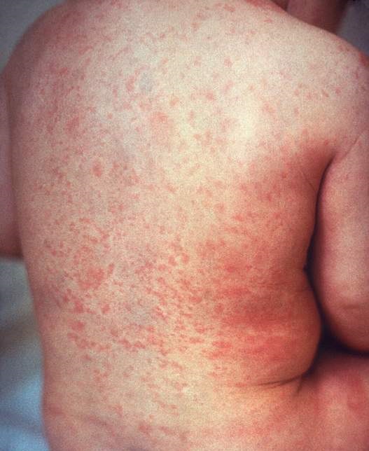 Photo showing a child with a rubella rash on their back