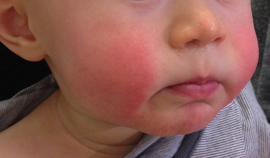 Photo showing a child with a fifth disease rash