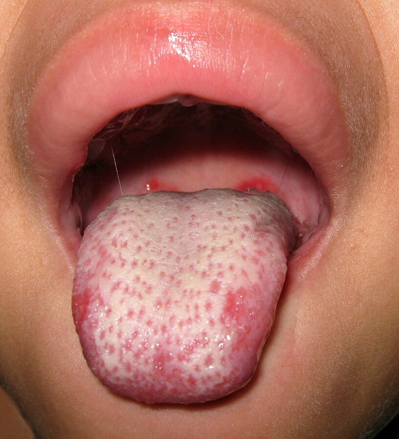 Photo showing a person with strawberry tongue