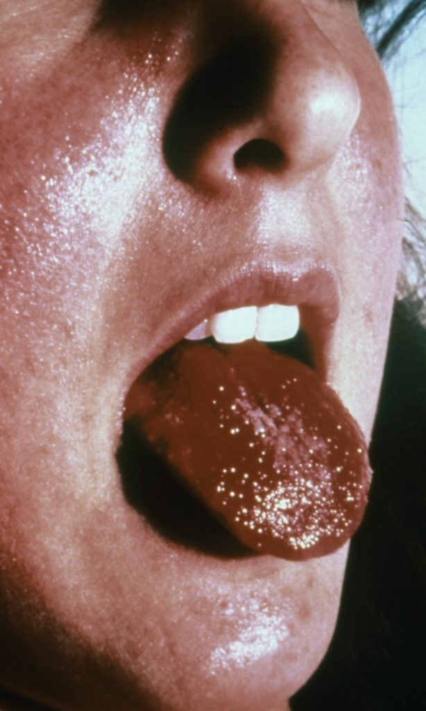 Photo showing a person with a strawberry tongue