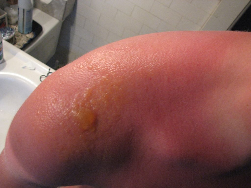 Photo showing blistering due to sunburn