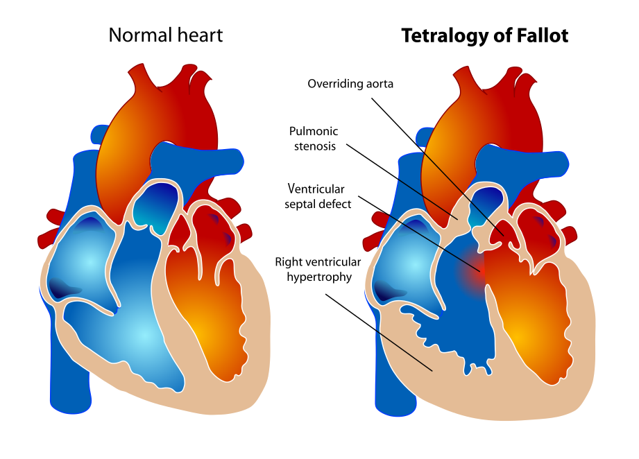 Illustration showing healthy heart compared to a heart with tetralogy of fallot