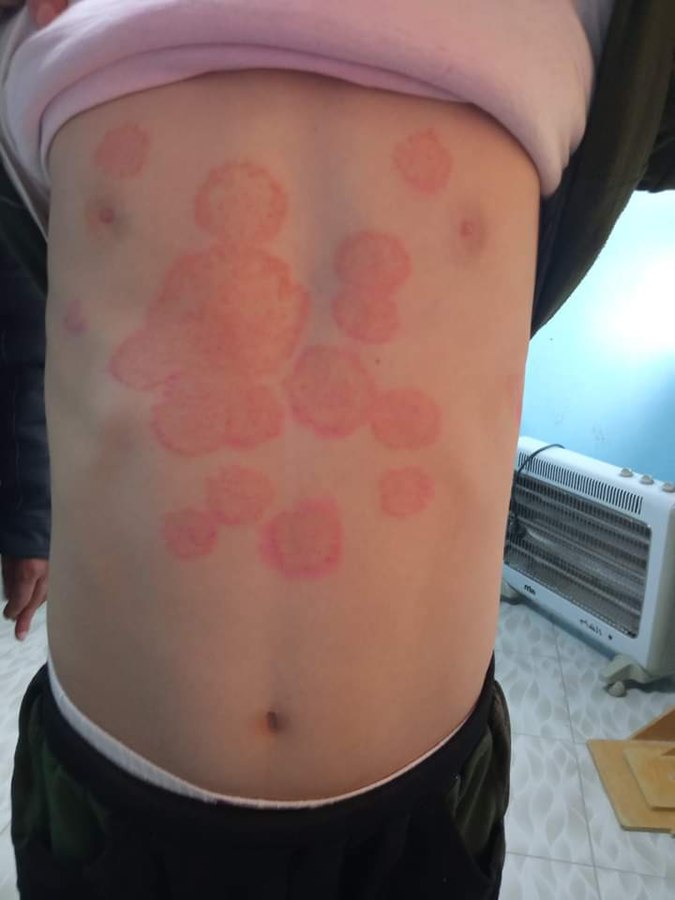 Photo showing tinea corporis on a person's torso