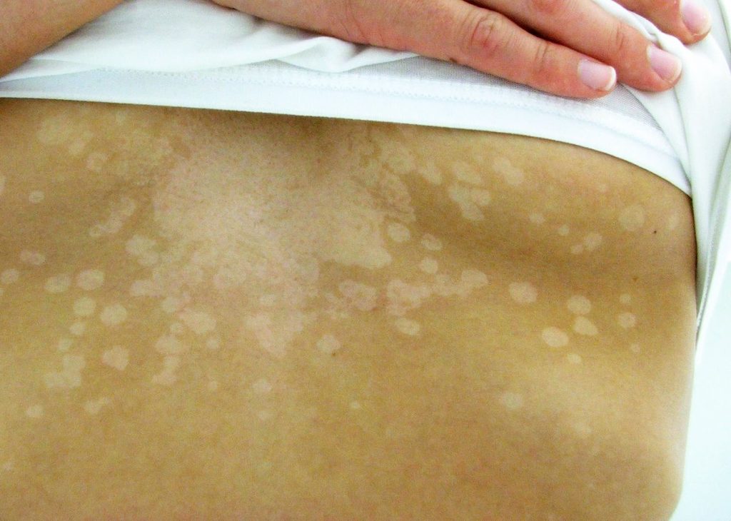 Photo showing Tinea Versicolor with Decreased Skin Pigmentation