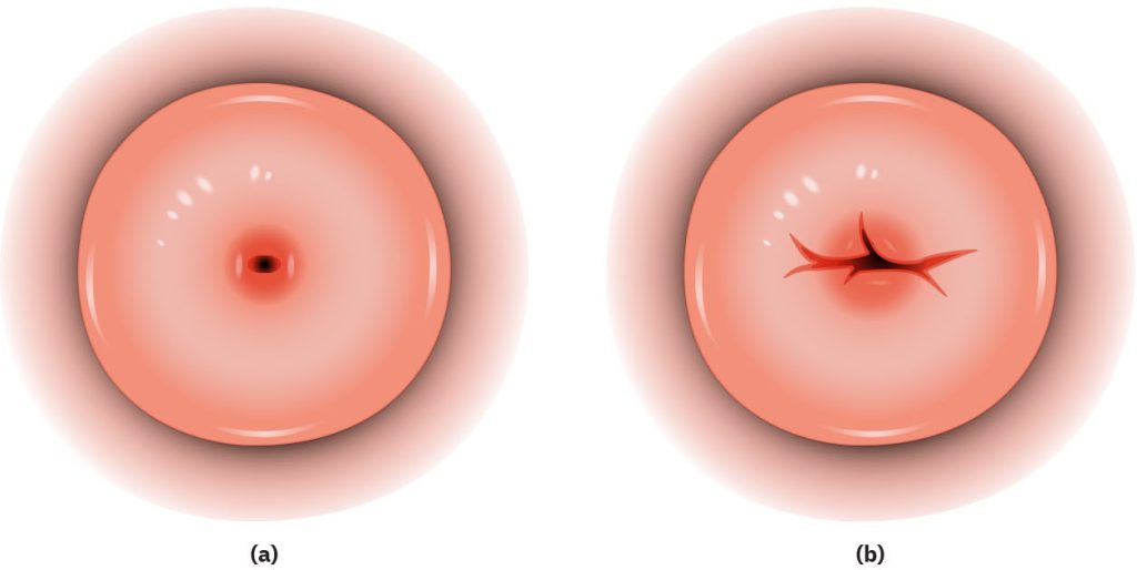 Illustration showing a comparison of the cervix of a woman who has never been pregnant or is pregnant for the first time is round and small (b) cervical os of a woman who has had one or more previous pregnancies that appears like a slit