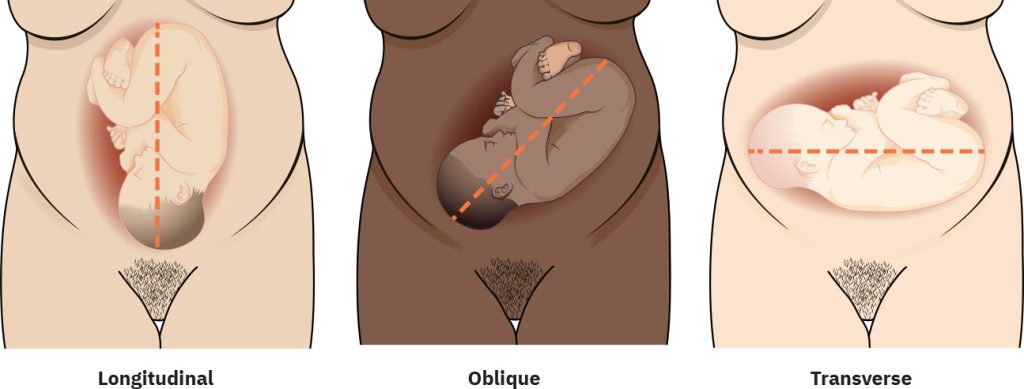 Illustration showing three positions for fetal lie