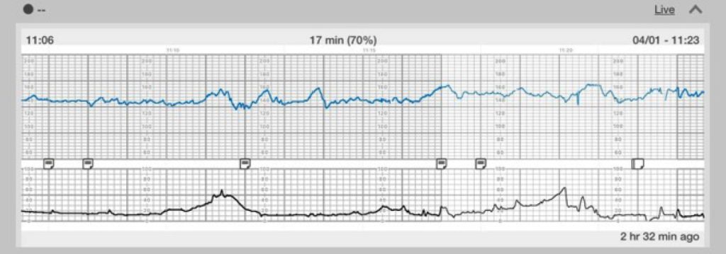 Image of graph showing Category I FHR Tracing