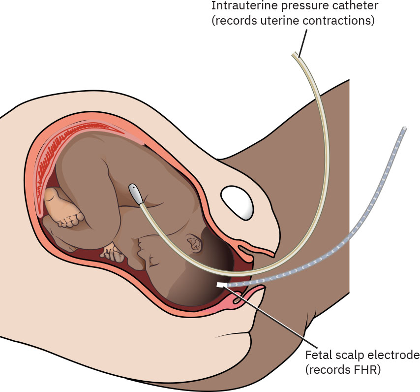 Illustration showing placement of continuous internal monitoring devices on a fetus