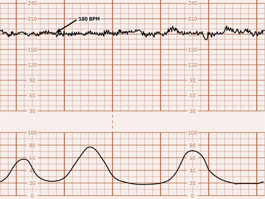 Image of graph paper showing fetal tachycardia