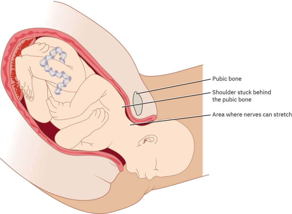 Illustration showing shoulder dystocia