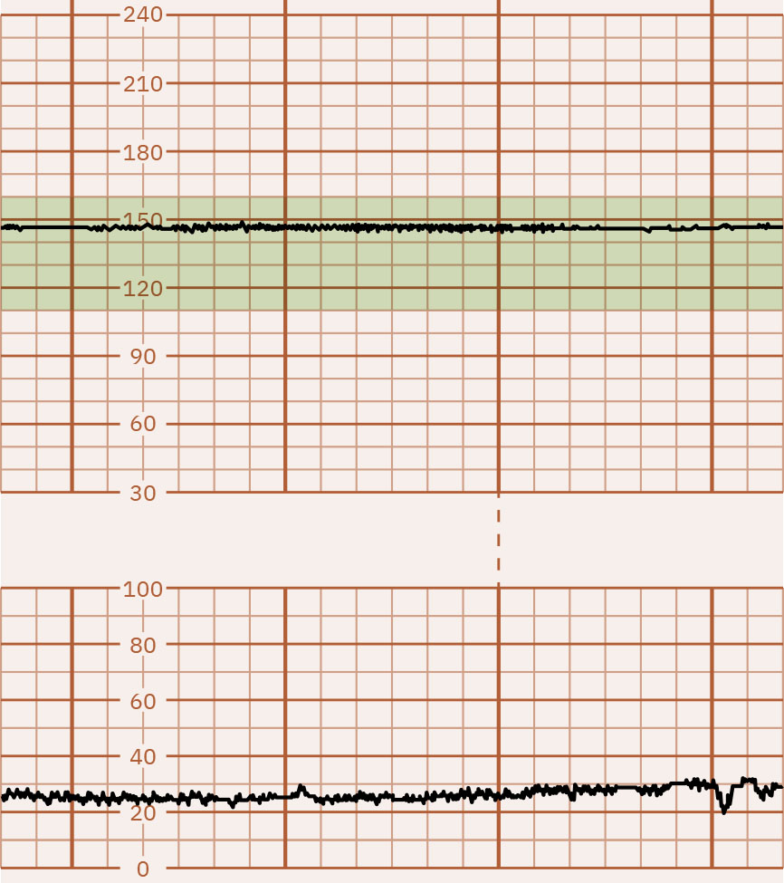 Image of graph paper showing absent FHR variability