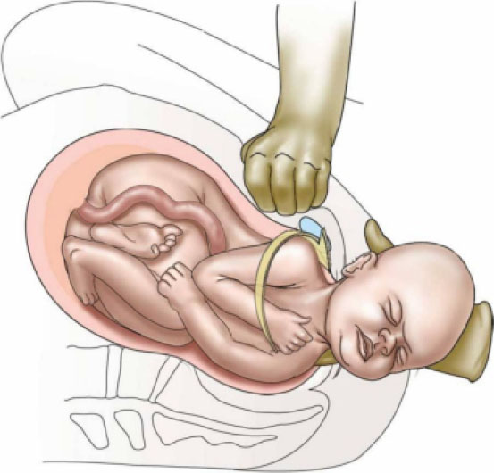 Illustration showing posterolateral suprapubic pressure