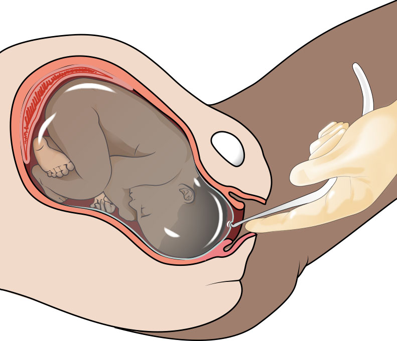 Illustration showing an amniotomy procedure