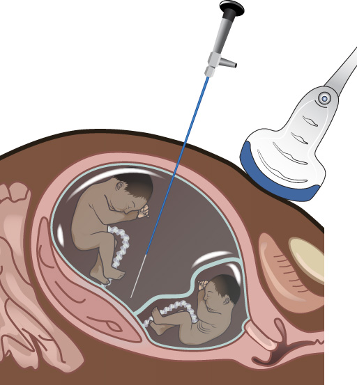 Illustration showing fetoscopy procedure