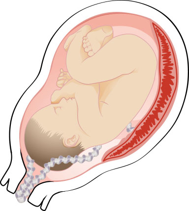 Illustration showing a prolapsed cord