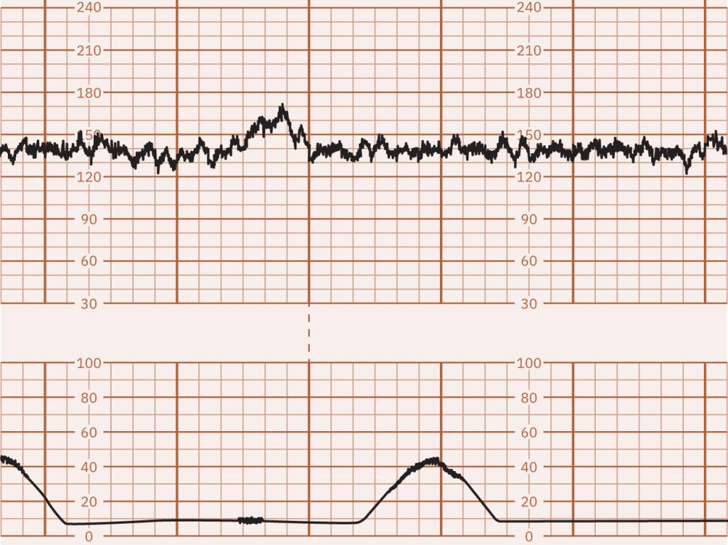 Image of graph paper showing periodic FHR Acceleration