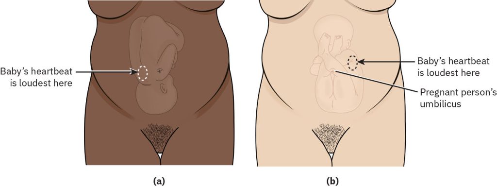 Illustration showing locations to listen to the FHR in vertex and breech presentations