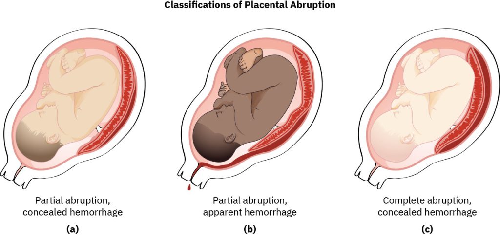 Illustration showing three classifications of placental abruption