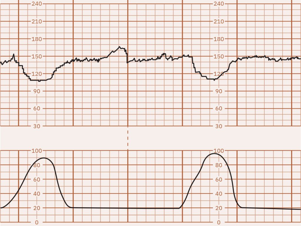 Image of graph paper showing early FHR decelerations