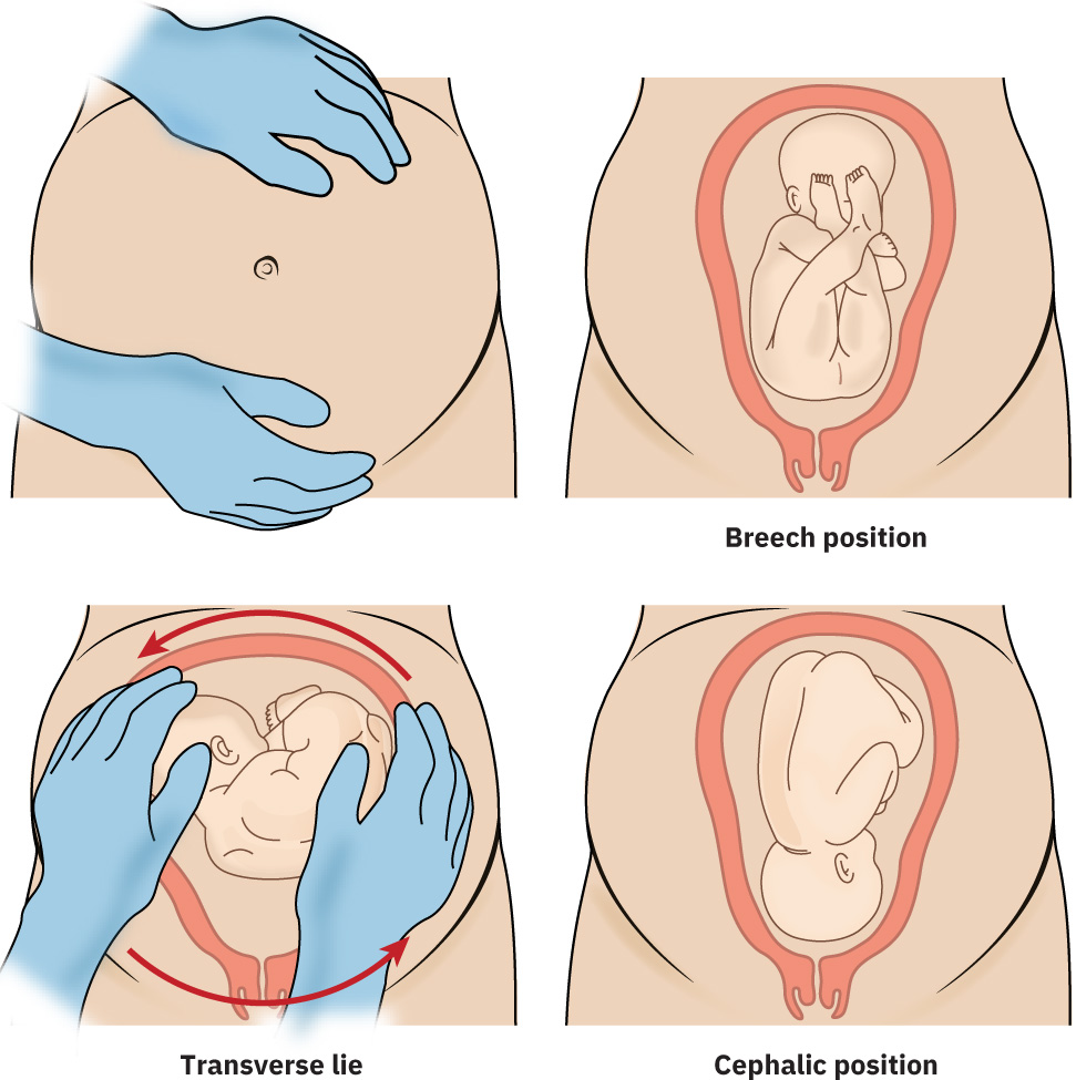 Illustration showing external cephalic version