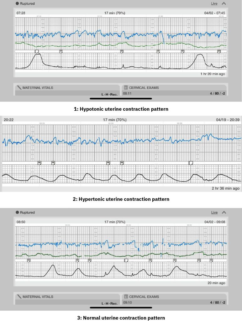 Image showing three graphs to show a Comparison of Fetal Monitoring Strips 1) Hypotonic Uterine Contraction Pattern, 2) Hypertonic Uterine Contraction Pattern, 3) Normal Uterine Contraction Pattern