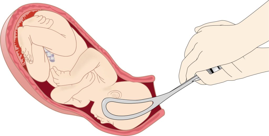 Illustration showing use of obstetric forceps