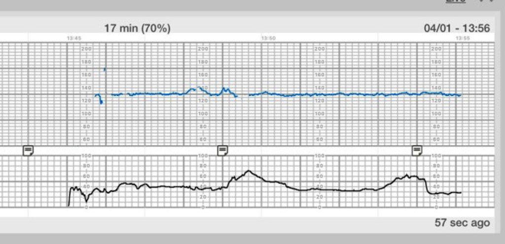 Image of graph showing category II FHR Tracing