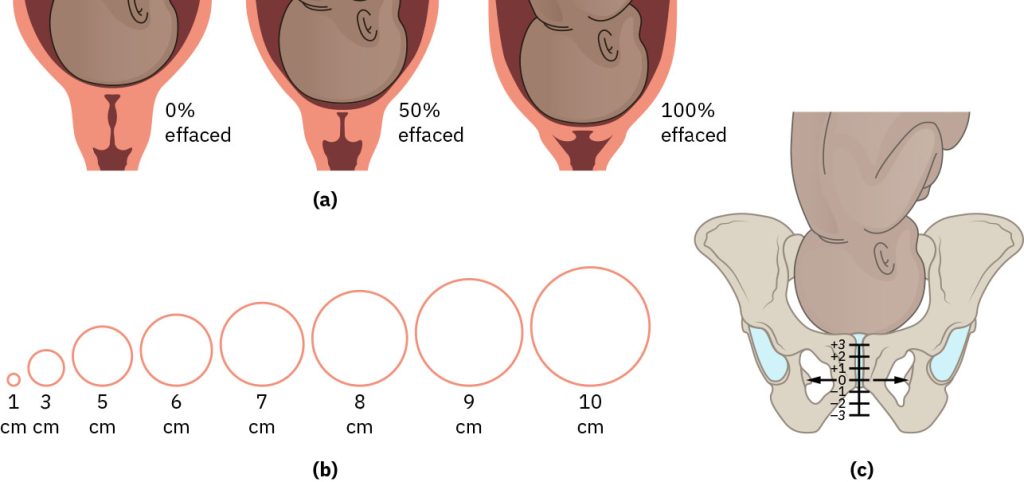 Illustration showing cervical effacement, dilation, and fetal station