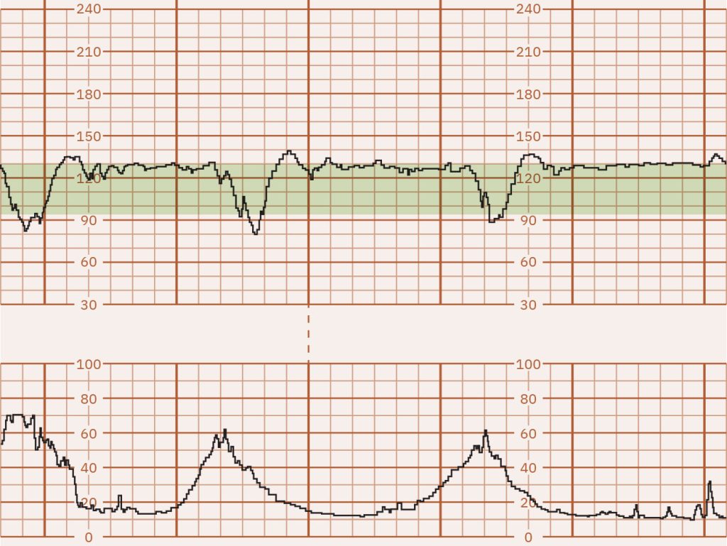 Image of graph paper showing variable decelerations