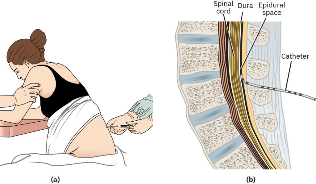 Illustration showing epidural anesthesia and closeup of internal placement