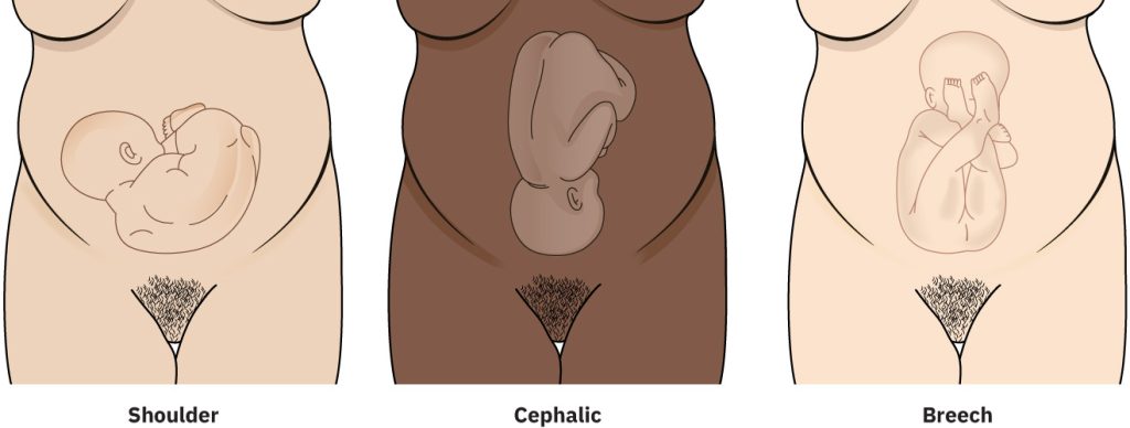 Illustration showing shoulder, cephalic and breech presentations of the fetus