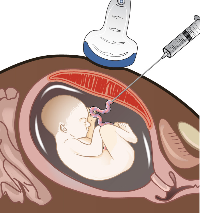 Illustration showing Percutaneous Umbilical Blood Sampling (PUBS)