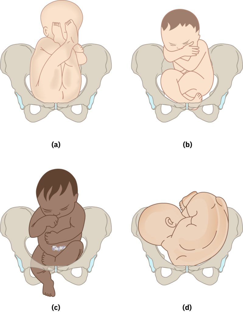 Illustration showing four breech presentations