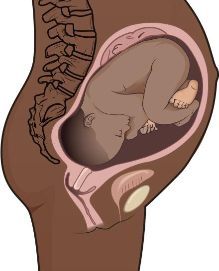 Illustration showing the occiput posterior presentation