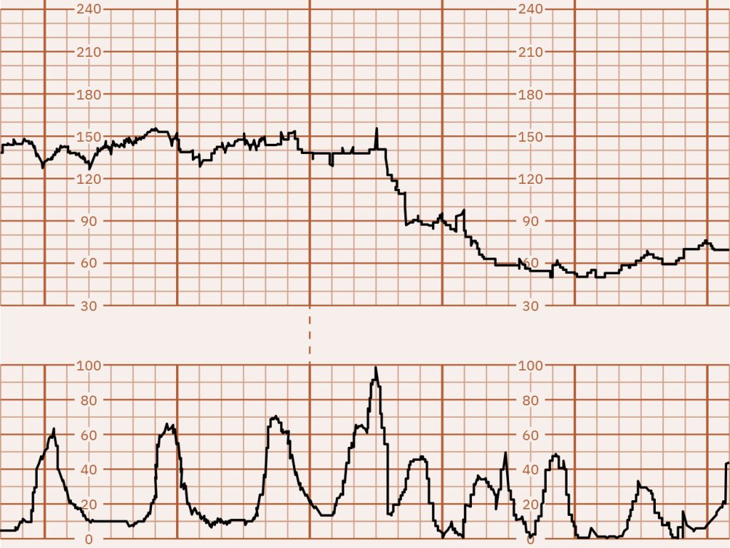 Image of graph paper showing prolonged deceleration caused by tachysystole