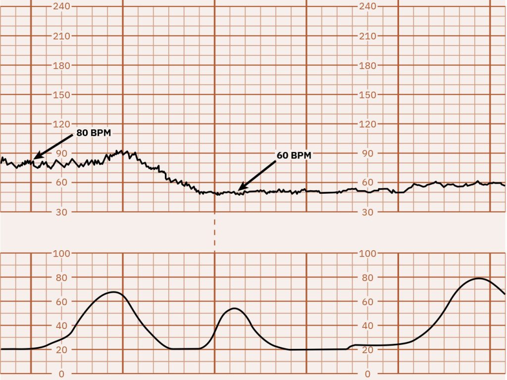 Image of graph paper showing fetal bradycardia