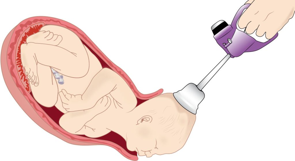 Illustration showing the use of a vacuum extractor