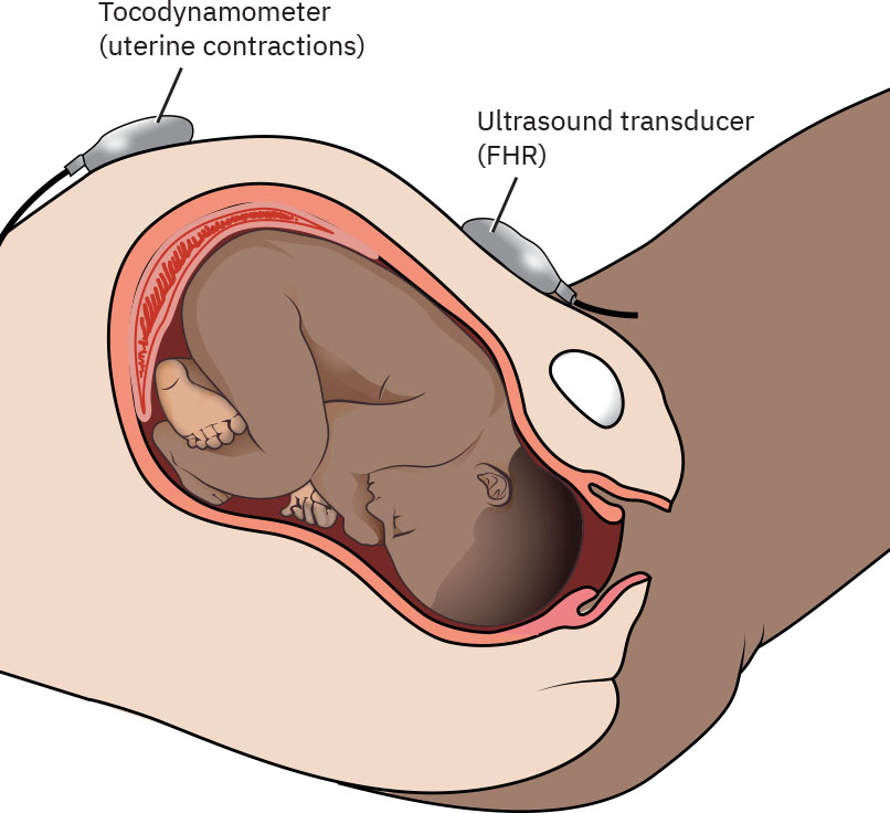 Illustration showing external monitoring of fetus with tocodynamometer and ultrasound transducer