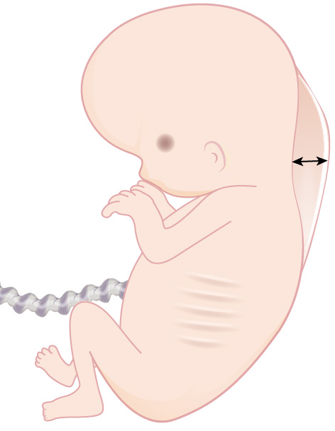 Illustration showing location of Nuchal Translucency