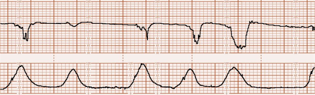 Image of graph paper showing Category III FHR Tracing