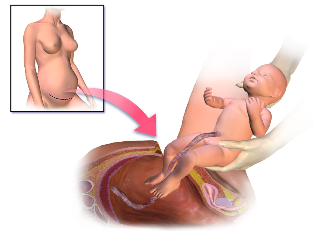 Computer illustration showing a cesarean section with callout box showing location of incision