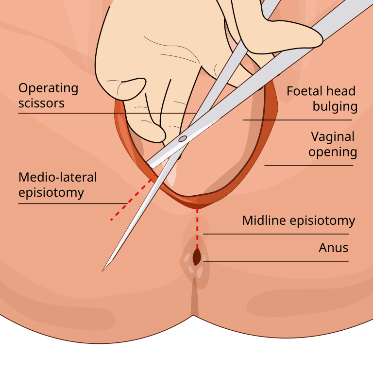 Illustration showing location and major structures involved in an episiotomy