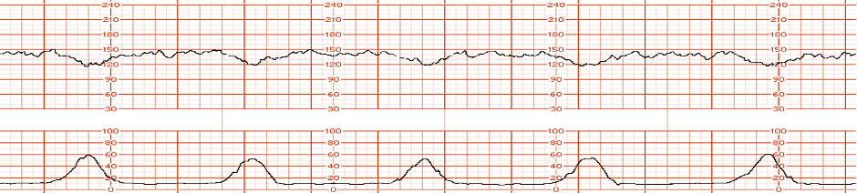 Image showing FHR tracing on graph paper