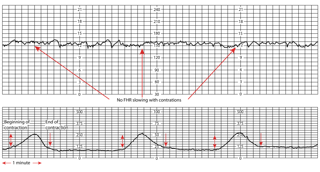 Image showing a graph with fetal heart rate and contraction measurements by external monitoring