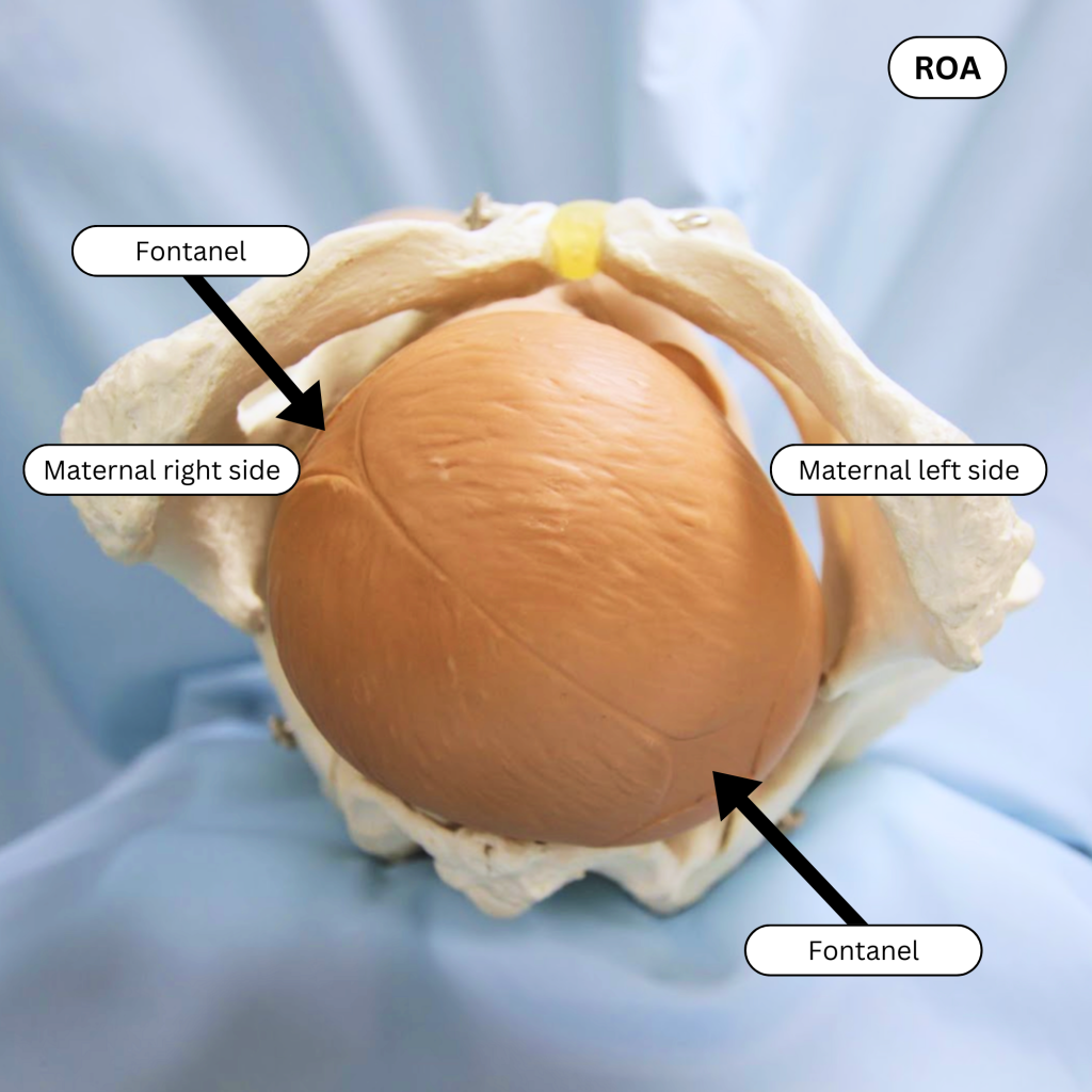 Photo showing ROA on a simulated newborn's head