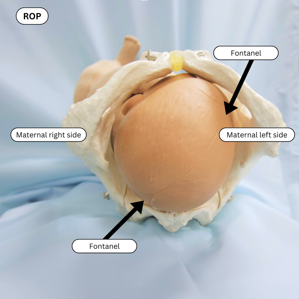 Photo showing ROP on a simulated newborn