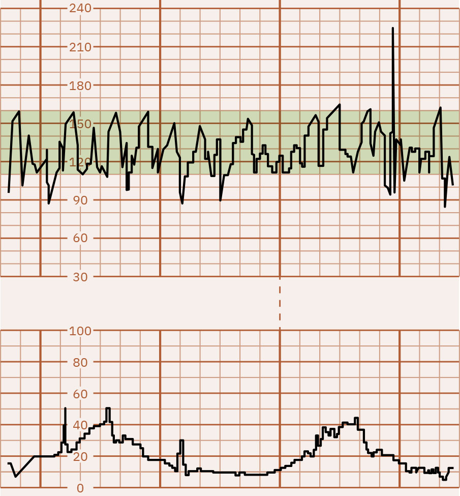 Image of graph paper showing marked FHR variability